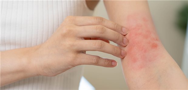 2011 wurden vierzehn vorrangige Fragestellungen zur optimalen Behandlung des Ekzems aus Sicht von Patienten und Angehörigen identifiziert. Die wichtigste Frage war: "Wie häufig sollten Menschen mit Ekzem baden oder duschen?“