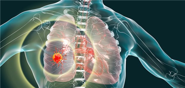 3 D-Darstellung eines Bronchialkarzinoms. Was sollten Betroffene wissen, wenn sie mit einer Immuntherapie behandelt werden?

