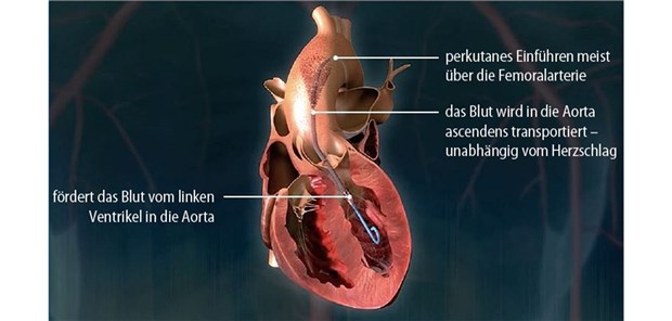 Abb. 1 Beispiel für eine linksventrikuläre Mikroaxialpumpe