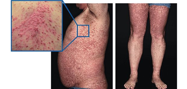 Abb. 1: Hautsymptome bei einem 61-jährigen männlichen Patienten mit indolenter systemischer Mastozytose: Multiple, monomorphe, rötlich-bräunliche Makulae; im Ausschnitt: Darier-Zeichen: provozierte Quaddelbildung und Rötung