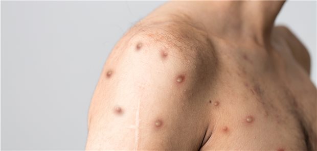 Die Entwicklungen rund um die Affenpocken Affenpocken auf dem Vormarsch: Immer mehr Länder melden Nachweise der seltenen Infektionskrankheit.