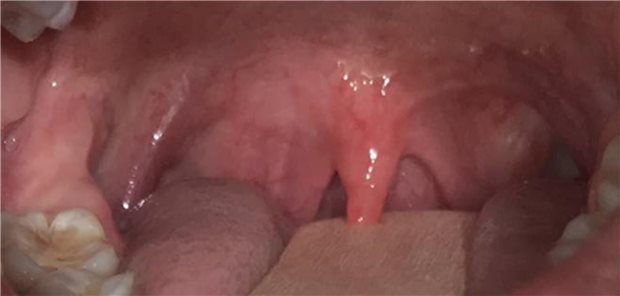 Kassenverband: Ambulante Mandel-Op nehmen zu! HNO-Verband: Stimmt nicht! Einblick in den Rachenraum