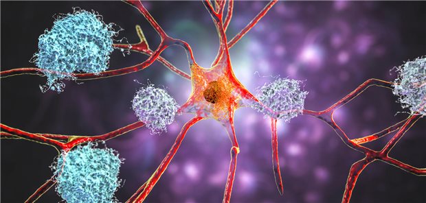 Amyloid-Plaques in Hirngewebe. Beim Aufspüren von Abnormalitäten in der Bildgebung könnte KI ein nützliches Werkzeug sein.