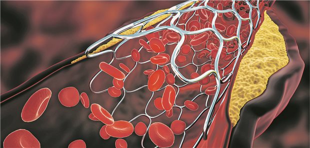 Stent in einer Arterie.