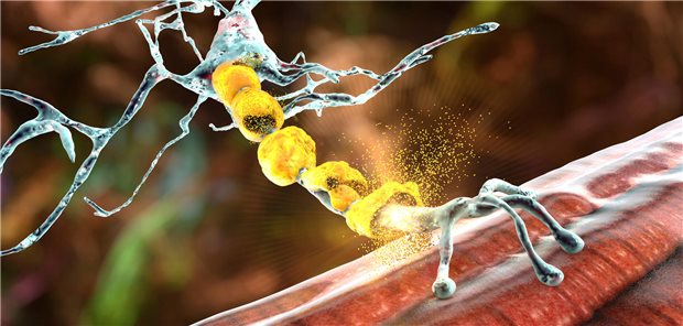 Dreidimenionale Illustration der Demyelinisierung von Neuronen, was zu einer Schädigung der Myelinscheide führt.