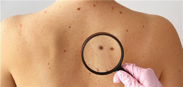 Auf der Suche nach schwarzem Hautkrebs: Anhand von Abrechnungsdaten hat das Zi für jeden deutschen Kreis die altersstandardisierte Diagnoseprävalenz des malignen Melanoms im Jahr 2019 ermittelt.