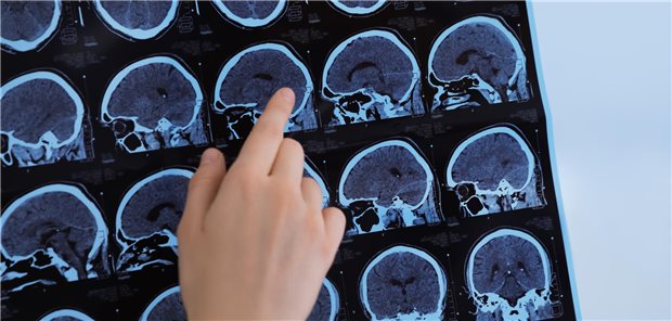 Nahaufnahme wie ein Arzt die MRT-Bilder eines Patienten mit Multipler Sklerose in einer Klinik untersucht.