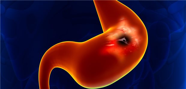 Dreidimensionale gerenderte Illustration eines Magengeschwürs.