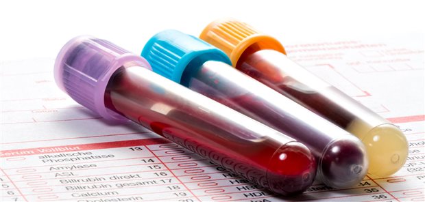 Bei SLE sollten zur Verlaufsdiagnostik dsDNA-Antikörper und die Komplementfaktoren C3 und C4 bestimmt werden. (Schmuckbild)