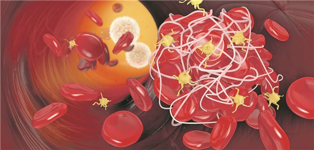 Venöse Thromboembolie: Vor- und Nachteile einer geringeren DOAK-Dosis Abbildung eines Thrombus in einem Gefäß.