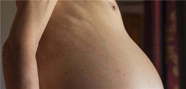 Aszites bei einer Person, die in der Nähe eines Fensters steht.