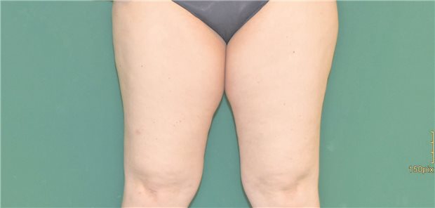 Diabetes und Lipödem: Warum dieses Paar besondere Aufmerksamkeit braucht Ein Lipödem im Stadium 1