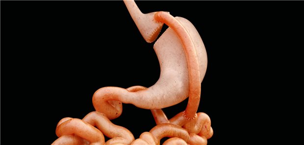 Beim Roux-en-Y-Magenbypass wird der Magen kurz nach dem Ösophagus chirurgisch durchtrennt und an den Dünndarm angeschlossen.