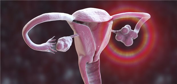 Beim polyzystischen Ovarialsyndrom finden sich definitionsgemäß mindestens 20 Follikel in einem Ovar und/oder das Volumen beträgt mindestens 10 mL. Der Malaria-Wirkstoff Artemisinin kann laut chinesischem Team Symptome lindern.