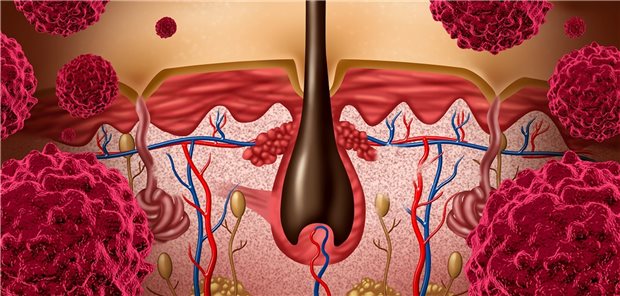 Frühe Diagnose und Therapie kann Lebensqualität deutlich verbessern Frühe Diagnose und Therapie kann Lebensqualität deutlich verbessern