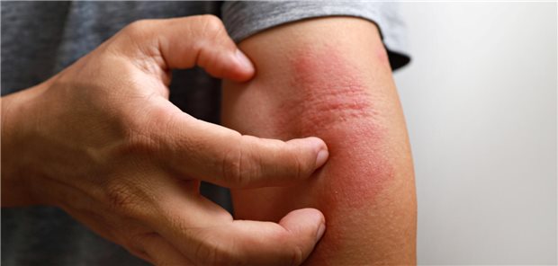 JAK-Inhibitoren: Was gibt es Neues aus Wissenschaft und Praxis? JAK-Inhibitoren: Was gibt es Neues aus Wissenschaft und Praxis?