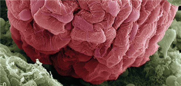 Komplement-3-Glomerulopathie (C3G): rechtzeitig erkennen, besser versorgen Komplement-3-Glomerulopathie (C3G): rechtzeitig erkennen, besser versorgen