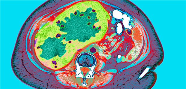 Die aktuelle Therapielandschaft beim HCC Die aktuelle Therapielandschaft beim HCC