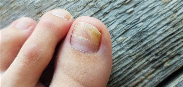 Effektive Therapie von Nagelpilz: Canesten® EXTRA Nagelset Effektive Therapie von Nagelpilz: Canesten® EXTRA Nagelset