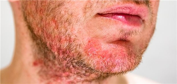 Alarmierender Anstieg: Hautpilz aus dem Barbershop Alarmierender Anstieg: Hautpilz aus dem Barbershop