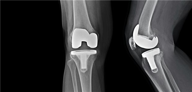 Ein Orthopäde erklärt anhand des Modell eines Kniegelenks das Prinzip eine Knieendoprothese.