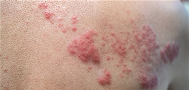 Blickdiagnose: klinisches Bild mit typischen Effloreszenzen bei Herpes zoster.