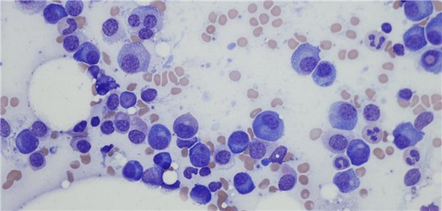 Blutausstrich bei multiplem Myelom