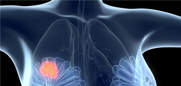 Fehlerhafte Befunde bei Brustkrebs-Patientinnen: Uni-Medizin Göttingen überprüft Untersuchungsergebn Brustkrebs-Befunde fehlerhaft interpretiert – das soll einer Ärztin am Klinikum Bremen passiert sein.