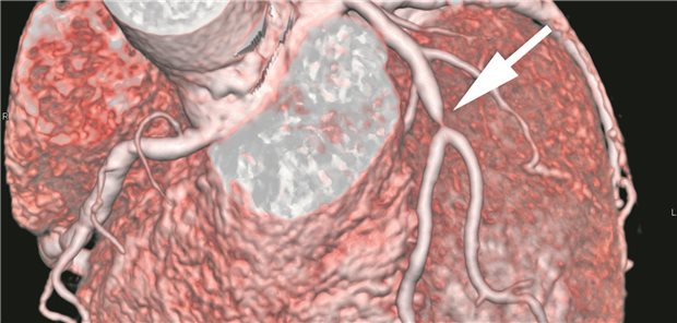 CCTA zur ambulanten KHK-Abklärung wird Kassenleistung CT-Angiographie des Herzens mit Nachweis einer ausgeprägten Koronarstenose.