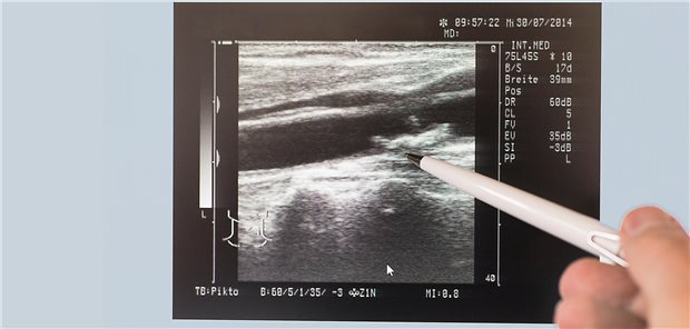 Carotis-Stenose im Ultraschall