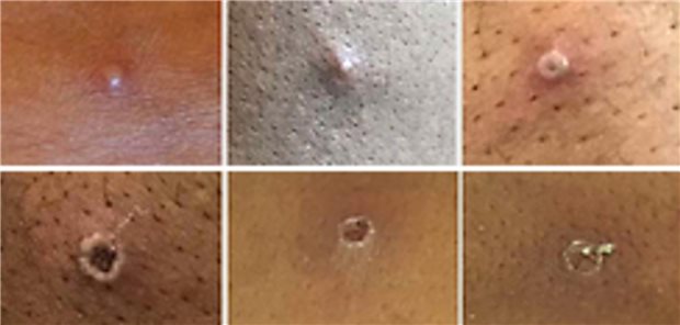 Charakteristisch für eine Infektion mit dem Affenpockenvirus: Die Hautläsionen (hier in verschiedenen Stadien).