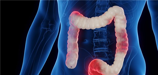 Chronisch-entzündliche Darmerkrankungen: In der CED-Pathophysiologie ist Interleukin 23 (IL-23) von zentraler Bedeutung.  Sebastian Kaulitzki / stock.adobe.com