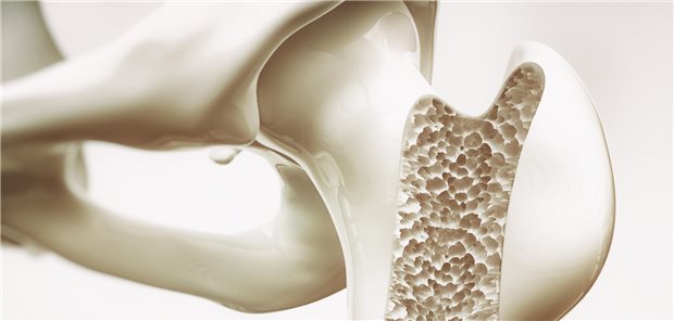 DMP Osteoporose: Wie Patienten und Praxen profitieren Das DMP Osteoporose wird regelmäßig evaluiert und angepasst. Anfang nächsten Jahres soll eine Neufassung im G-BA beraten werden.