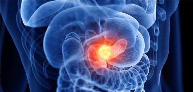 Das Pankreas­karzinom weist neben dem Meso­theliom die niedrigste Über­lebens­rate unter allen Krebs­erkrankungen auf, belegen Krebsdaten.