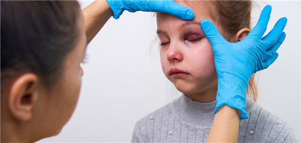 Kindesmisshandlung identifizieren? Eine Diagnosemethode greift Ärzten unter die Arme Nahaufnahme wie eine Ärztin den Bluterguss am linken Auge eines Mädchens untersucht.