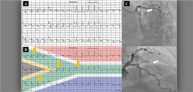 Ein EKG mit einem „Südafrikanische Flagge-Zeichen“. 