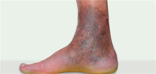 Veränderungen der Eigenschaften der Haut an den unteren Extremitäten als Folge von Krampfadern.