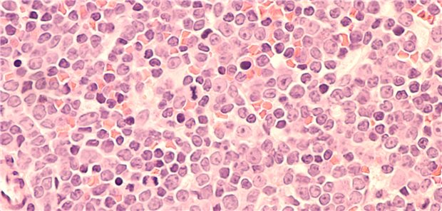 Das diffus großzellige B-Zell-Lymphom (DLBCL) schreitet rasch voran. Nach einem Rückfall zählt Rituximab + Gemcitabin-Oxaliplatin zu den Standardtherapien. In der waveLINE-003-Studie wurde diese jetzt mit Zilovertamab-Vedotin kombiniert.