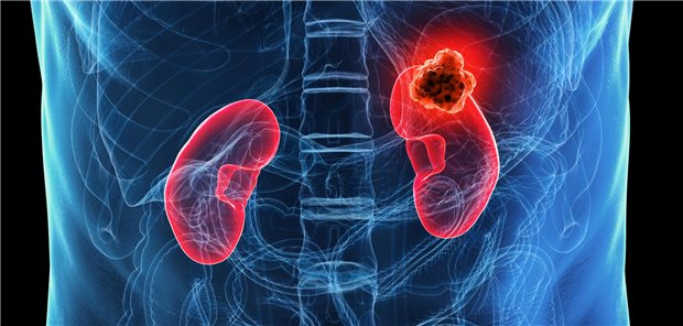 Dreidimensionale gerenderte medizinische Illustration von einem fortgeschrittenen Nierenzellkarzinom.