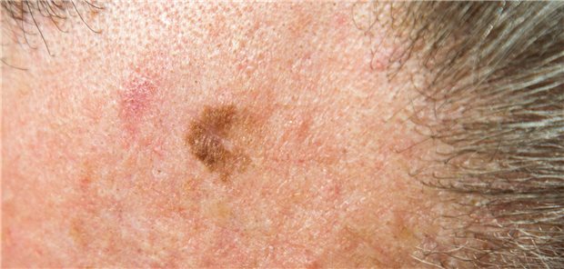 Bei inoperabler Lentigo maligna: Imiquimod oder Strahlentherapie? Malignes Lentigo (Melanom in situ) auf der Stirn eines 64-jährigen Mannes.