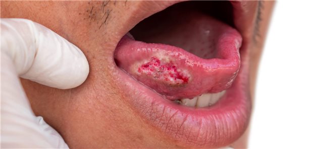 Krebsrisiko: Wie gefährlich sind suspekte Veränderungen in der Mundhöhle? Plattenepithelkarzinom der Zunge bei einem männlichen Patienten.