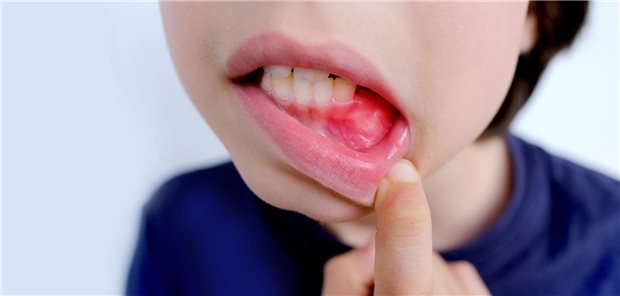 Nahaufnahme eines 10-jährigen Jungen, der seinen Mund geöffnet hat. Zu sehen sind seine Zähne und sein gerötetes Zahnfleisch.