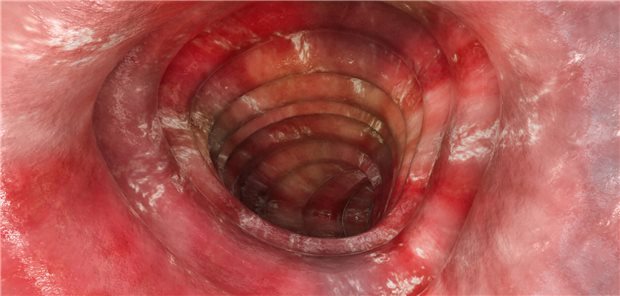 Die Autorinnen und Autoren resümieren, dass bei der Behandlung von Patienten mit steroidrefraktärer Colitis ulcerosa weder eine dosisintensivierte noch eine akzelerierte Rescue-Strategien mit Infliximab geeignet waren.