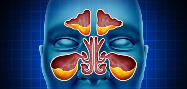 Chronischer Rhinosinusitis ist eine Verstopfungskrankheit der Nase, bei der die Nasenhöhle mit Schleim oder Eiter verstopft ist.