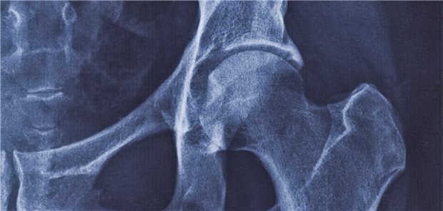 Die Darmgesundheit zu fördern, kann positiv auf eine Coxarthrose wirken.