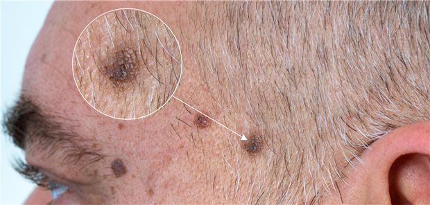 Mann mit Melanom