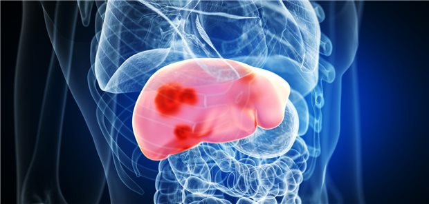 Dreidimensionale gerenderte medizinisch korrekte Darstellung von Lebertumoren.