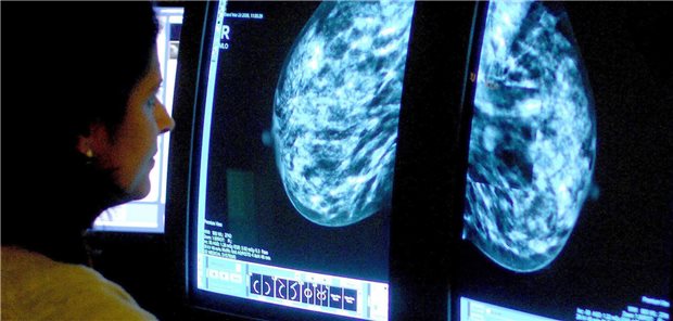 Die Teilnahmerate am Brustkrebs-Screening liegt in Deutschland bei 45 Prozent, in der OECD im Mittel bei 55 Prozent, in Skandinavien sogar zwischen 70 und 83 Prozent.