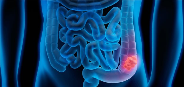Die altersstandardisierte Diagnoseprävalenz von Darmkrebs lag 2019 im Bundesschnitt bei 0,54 Prozent.
