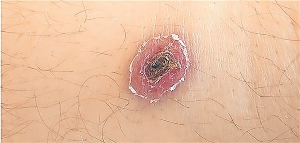 Eschar am medialen Oberschenkel links.